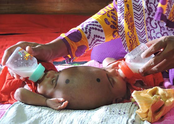 أخيرًا عملية لفصل التوأم الملتصق من الرأس رقية وربيعة صورة رقم 1