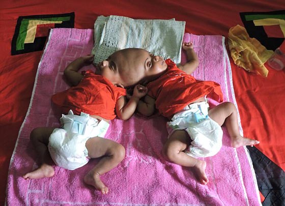 أخيرًا عملية لفصل التوأم الملتصق من الرأس رقية وربيعة صورة رقم 9