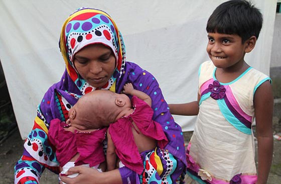 أخيرًا عملية لفصل التوأم الملتصق من الرأس رقية وربيعة صورة رقم 10