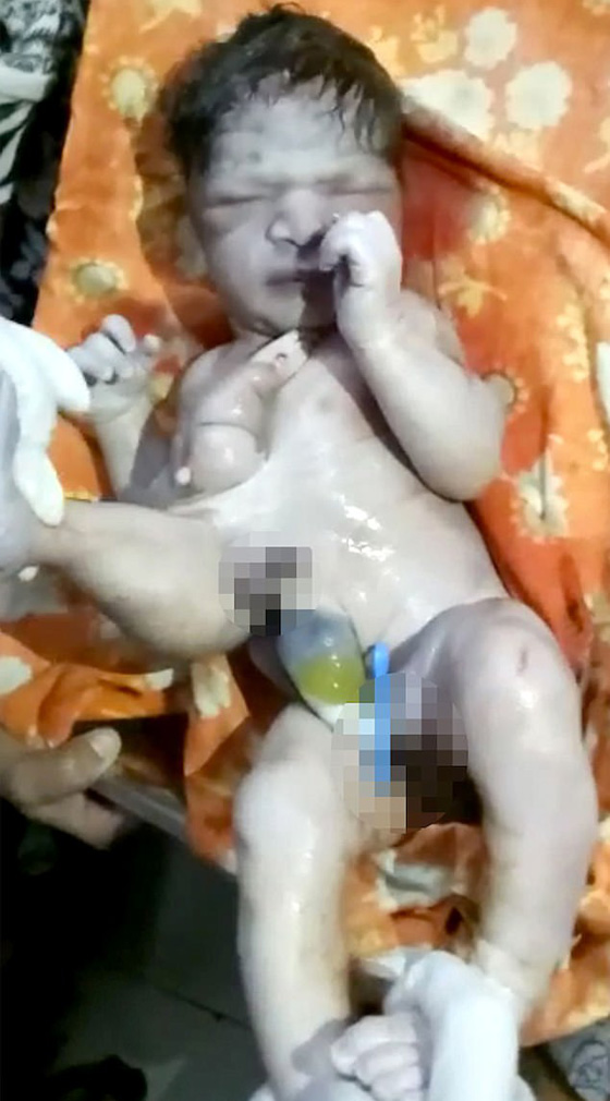 طبيب ينقذ طفلا ولد بـ4 سيقان و3 أذرع قبل ان ترميه عائلته في النهر! صورة رقم 3