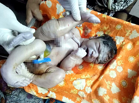 طبيب ينقذ طفلا ولد بـ4 سيقان و3 أذرع قبل ان ترميه عائلته في النهر! صورة رقم 4