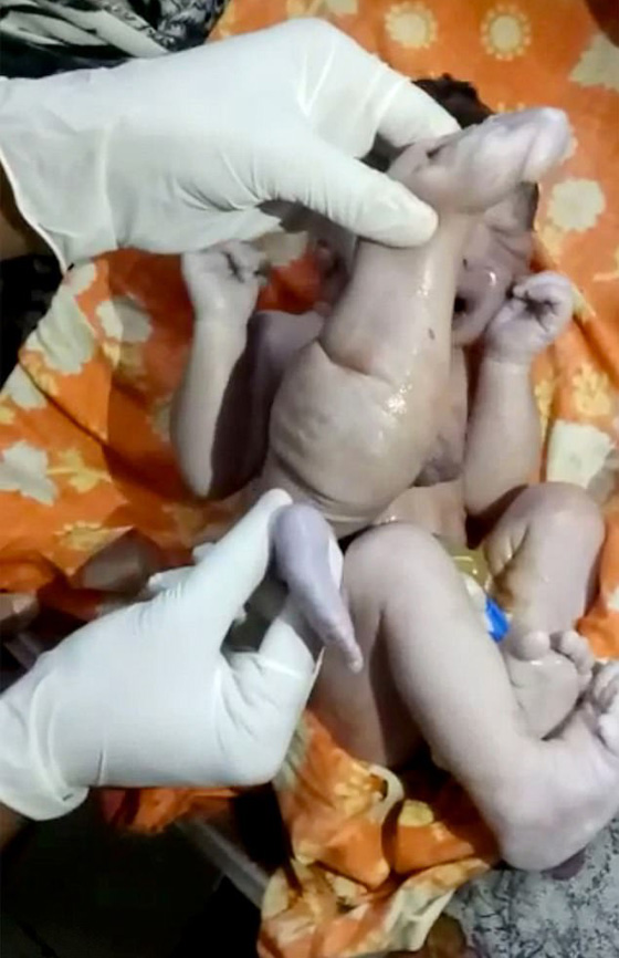 طبيب ينقذ طفلا ولد بـ4 سيقان و3 أذرع قبل ان ترميه عائلته في النهر! صورة رقم 5