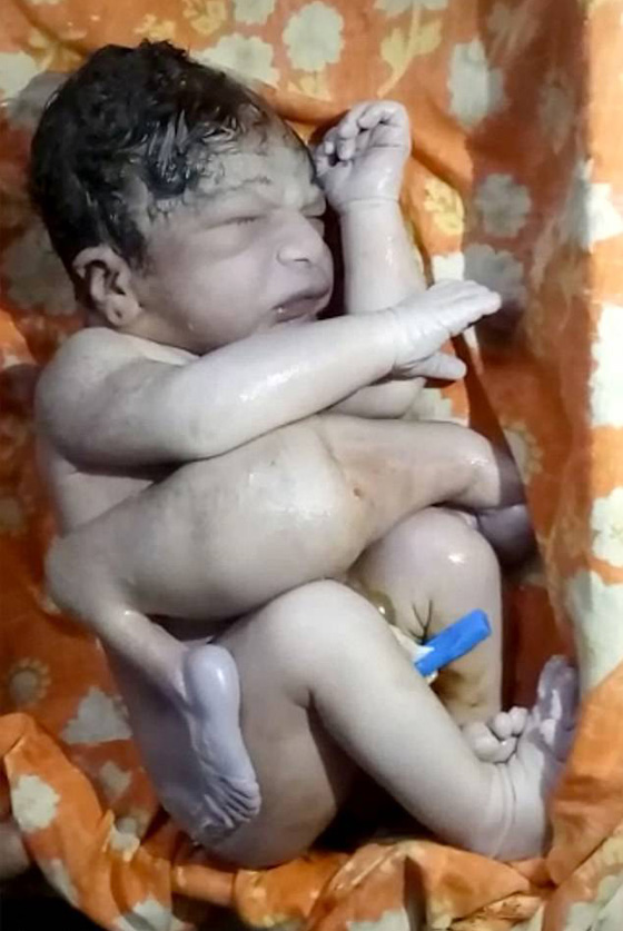 طبيب ينقذ طفلا ولد بـ4 سيقان و3 أذرع قبل ان ترميه عائلته في النهر! صورة رقم 6