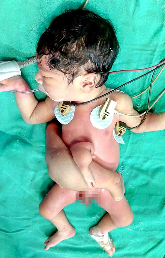 طبيب ينقذ طفلا ولد بـ4 سيقان و3 أذرع قبل ان ترميه عائلته في النهر! صورة رقم 2