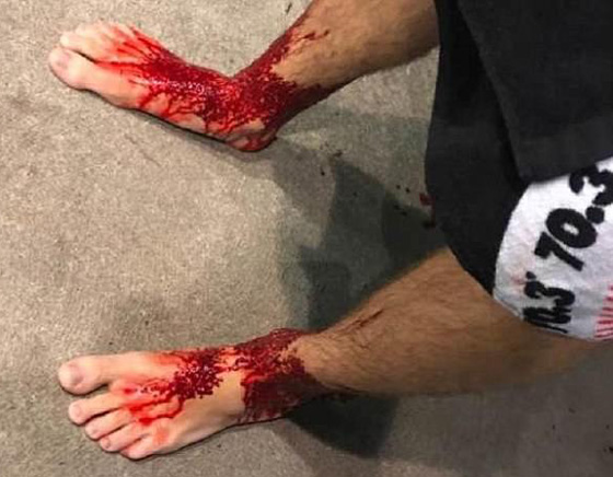 بالفيديو والصور.. ناهشات للحوم هاجمت هذا المراهق وكادت أن تنهي حياته  صورة رقم 3