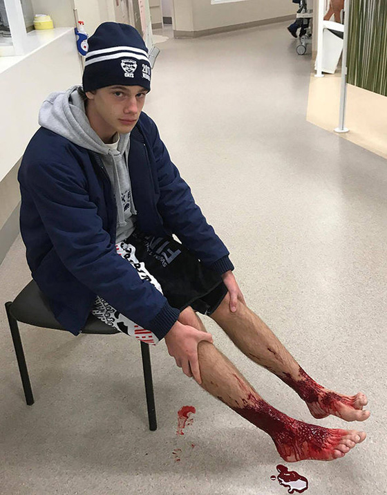 بالفيديو والصور.. ناهشات للحوم هاجمت هذا المراهق وكادت أن تنهي حياته  صورة رقم 1