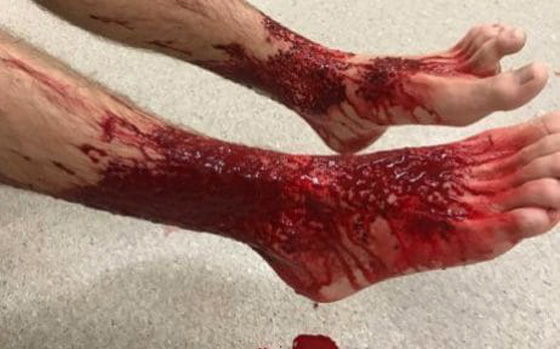 بالفيديو والصور.. ناهشات للحوم هاجمت هذا المراهق وكادت أن تنهي حياته  صورة رقم 4