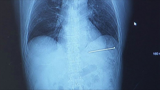 بالفيديو والصور.. مسمار يخترق قلب رجل أمريكي أطلقه على نفسه بالخطأ صورة رقم 2