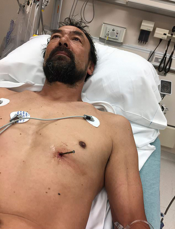 بالفيديو والصور.. مسمار يخترق قلب رجل أمريكي أطلقه على نفسه بالخطأ صورة رقم 1