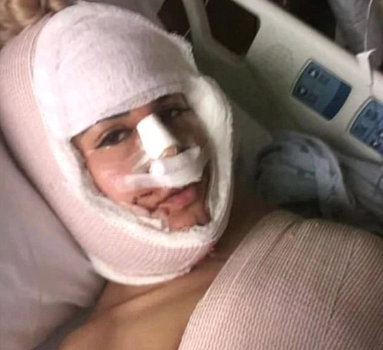 الهوس! أجرت 13 عملية جراحية في أقل من سنة لتشبه إيفانكا ترامب صورة رقم 1