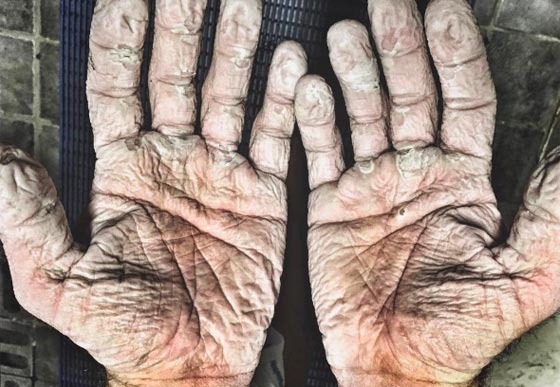 هكذا تبدو أيدي البطل الأولمبي في التجديف الذي جاب المحيط المتجمد الشمالي.. صورة رقم 2