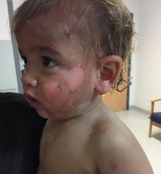 حروق مروعة على وجه وجسم طفل صغير بسبب اهمال عاملة الحضانة!! صورة رقم 2