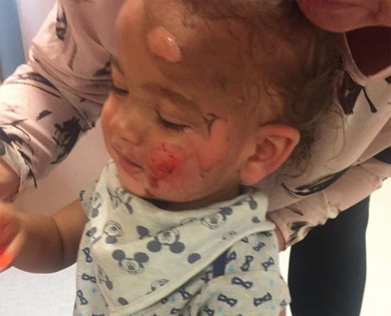 حروق مروعة على وجه وجسم طفل صغير بسبب اهمال عاملة الحضانة!! صورة رقم 1