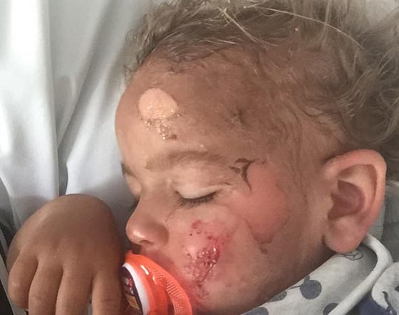 حروق مروعة على وجه وجسم طفل صغير بسبب اهمال عاملة الحضانة!! صورة رقم 4