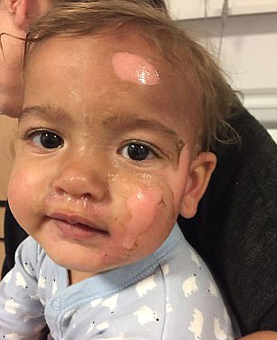 حروق مروعة على وجه وجسم طفل صغير بسبب اهمال عاملة الحضانة!! صورة رقم 5