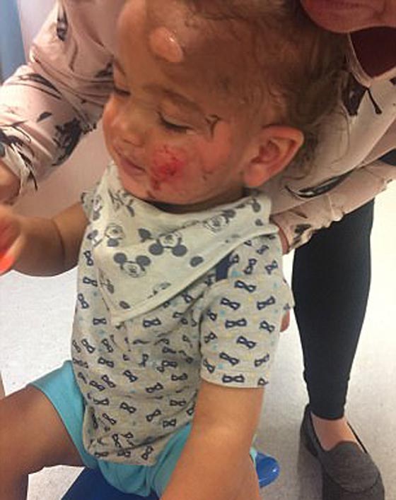 حروق مروعة على وجه وجسم طفل صغير بسبب اهمال عاملة الحضانة!! صورة رقم 6