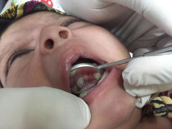 اطباء يقتلعون 7 اسنان من فم طفل عمره شهر لمساعدته على الرضاعة صورة رقم 2