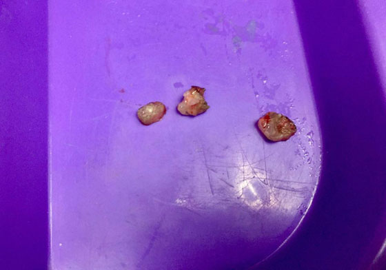 اطباء يقتلعون 7 اسنان من فم طفل عمره شهر لمساعدته على الرضاعة صورة رقم 4