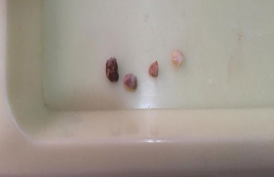 اطباء يقتلعون 7 اسنان من فم طفل عمره شهر لمساعدته على الرضاعة صورة رقم 5