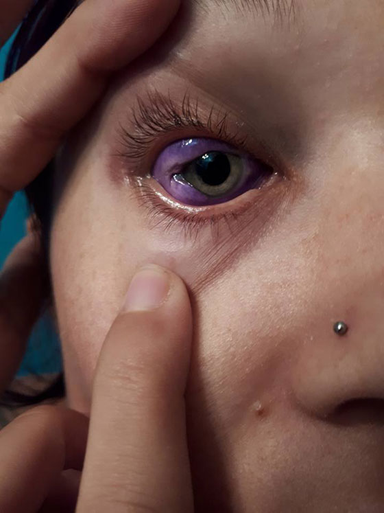 آخر صيحات الموضة.. عارضة أزياء كندية تتعرَّض لعمىً جزئيٍّ والسبب؟ صورة رقم 2