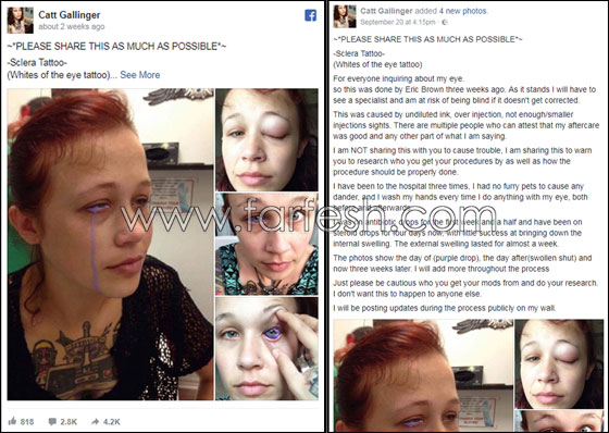 آخر صيحات الموضة.. عارضة أزياء كندية تتعرَّض لعمىً جزئيٍّ والسبب؟ صورة رقم 4