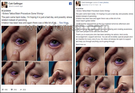 آخر صيحات الموضة.. عارضة أزياء كندية تتعرَّض لعمىً جزئيٍّ والسبب؟ صورة رقم 5