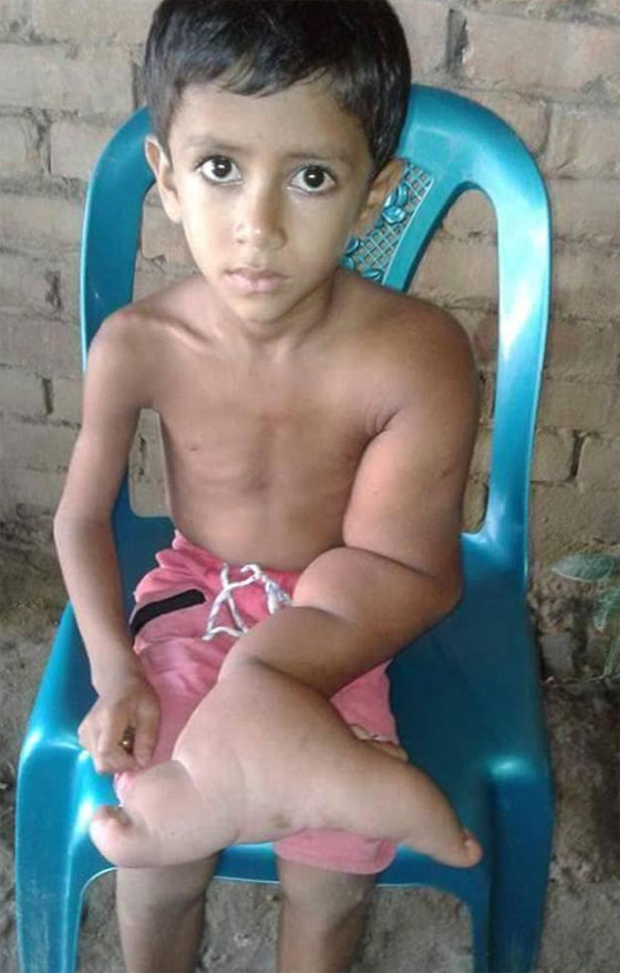  يد الشيطان.. حالة مرضية نادرة تجبر طفل على حياة العزلة! صورة رقم 1