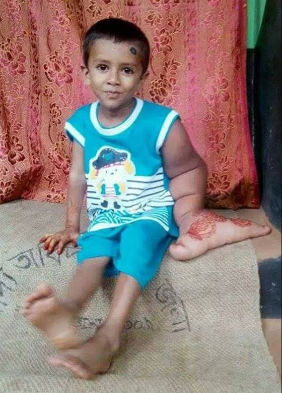  يد الشيطان.. حالة مرضية نادرة تجبر طفل على حياة العزلة! صورة رقم 2