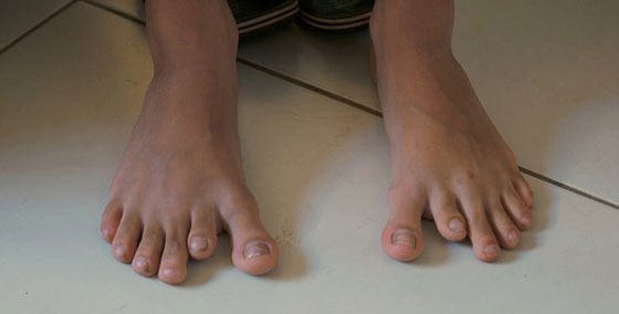 عائلةٌ برازيلية أفرادها بـ6 أصابع حولتهم معاناتهم إلى مشهورين صورة رقم 3 عائلةٌ برازيلية أفرادها بـ6 أصابع حولتهم معاناتهم إلى مشهورين صورة رقم 3