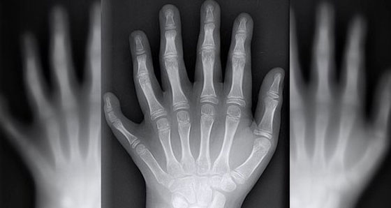 عائلةٌ برازيلية أفرادها بـ6 أصابع حولتهم معاناتهم إلى مشهورين صورة رقم 7 عائلةٌ برازيلية أفرادها بـ6 أصابع حولتهم معاناتهم إلى مشهورين صورة رقم 7