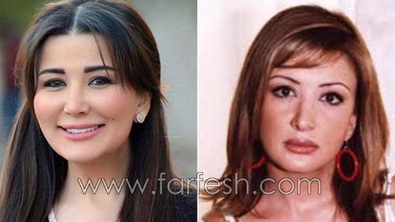 صور نجمات الفن قبل وبعد عمليات التجميل.. البعض تشوه وجههن! صورة رقم 9