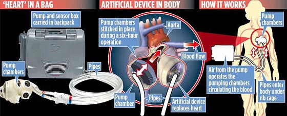 مسلمة بريطانية بدون قلب في جسدها وتحمل قلبها الصناعي في حقيبة! صورة رقم 2