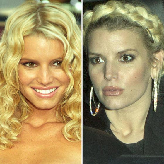 10 نجمات من هوليوود يعترفن بإجراء عمليات التجميل - صور قبل وبعد   صورة رقم 8