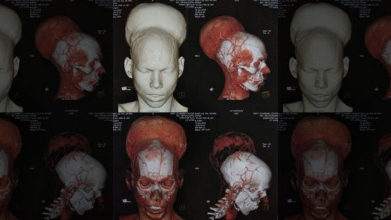 رأسان بواحد.. صور شاب هندي بورم قياسي صورة رقم 5 رأسان بواحد.. صور شاب هندي بورم قياسي صورة رقم 5