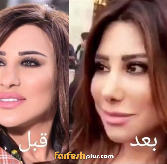 عملية تجميل جديدة تشوه جمال نجوى كرم! شاهد الفيديو والصور صورة رقم 1