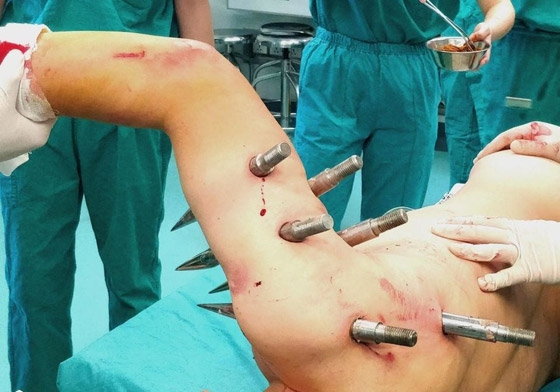 صور مرعبة: عامل مصنع يواجه الموت حين اخترقت جسمه 10 قضبان حديدية صورة رقم 3