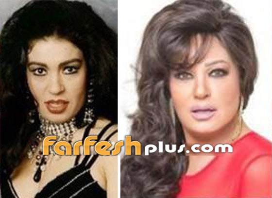 صور نجمات الفن قبل وبعد عمليات التجميل.. البعض تشوه وجههن! صورة رقم 15