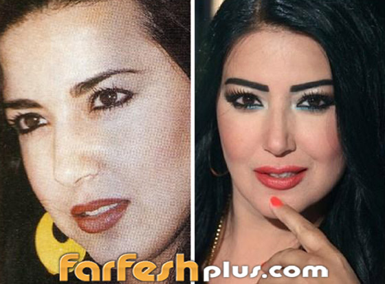 صور نجمات الفن قبل وبعد عمليات التجميل.. البعض تشوه وجههن! صورة رقم 16