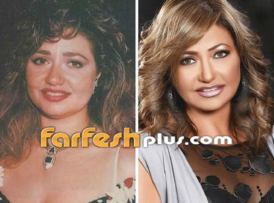 صور نجمات الفن قبل وبعد عمليات التجميل.. البعض تشوه وجههن! صورة رقم 17