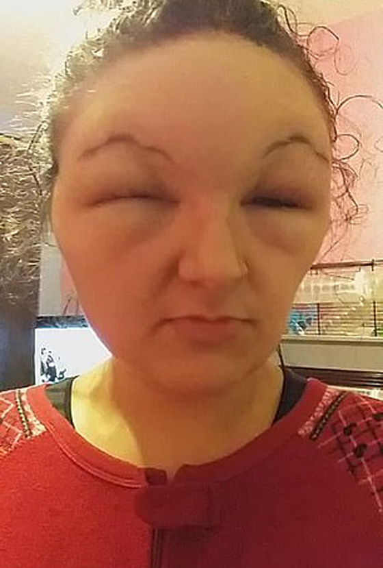 صبغة شعر تتسبب بتضخم وجه مراهقة وتصيبها بالعمى لمدة يومين! صور صورة رقم 2