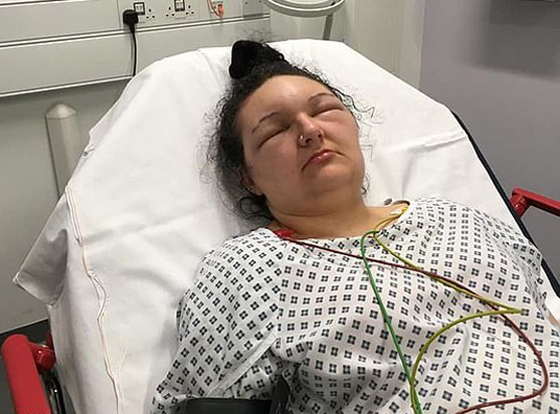 صبغة شعر تتسبب بتضخم وجه مراهقة وتصيبها بالعمى لمدة يومين! صور صورة رقم 3