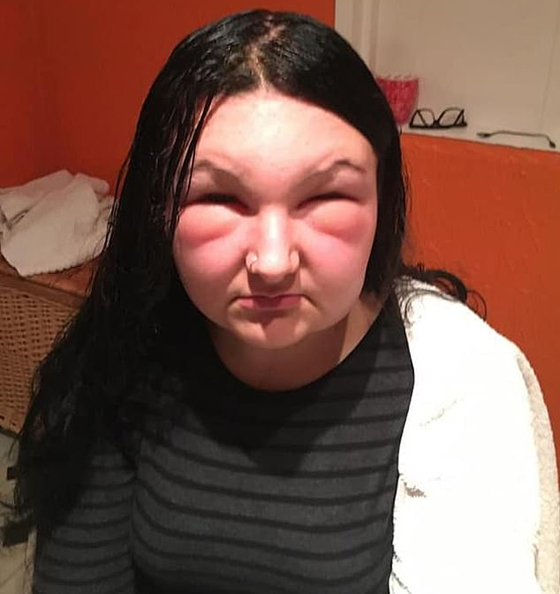 صبغة شعر تتسبب بتضخم وجه مراهقة وتصيبها بالعمى لمدة يومين! صور صورة رقم 4