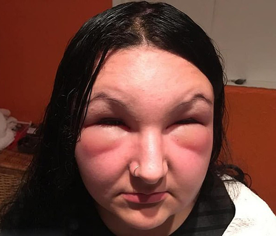 صبغة شعر تتسبب بتضخم وجه مراهقة وتصيبها بالعمى لمدة يومين! صور صورة رقم 5