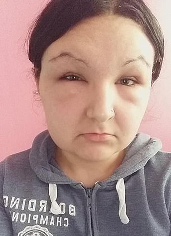 صبغة شعر تتسبب بتضخم وجه مراهقة وتصيبها بالعمى لمدة يومين! صور صورة رقم 6