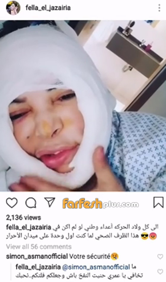  فيديو صادم: ما الذي حدث لوجه فلة الجزائرية وكيف تشوه وانتفخ بهذا الشكل؟؟ صورة رقم 2