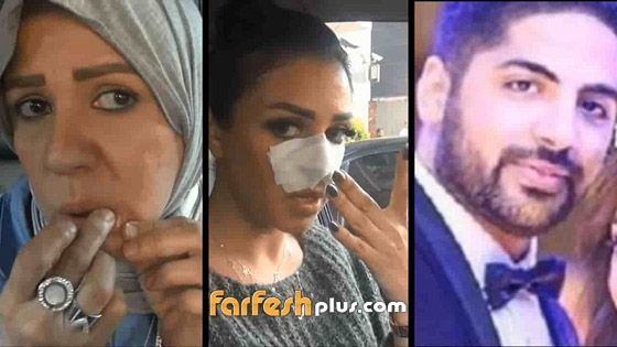 المطربة شاهيناز: طليقي ضربني بعنف واعتدى على أمي وخطف ابني.. صور صادمه صورة رقم 2