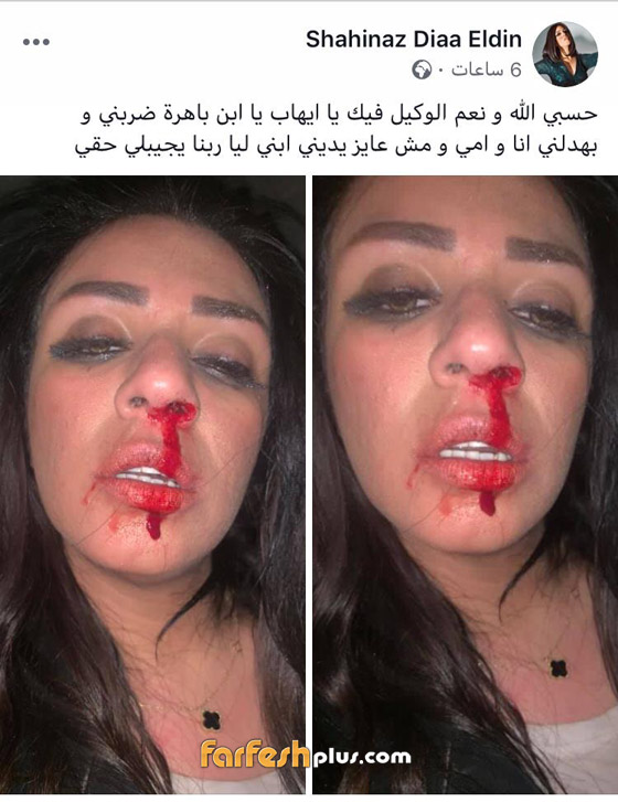 المطربة شاهيناز: طليقي ضربني بعنف واعتدى على أمي وخطف ابني.. صور صادمه صورة رقم 1