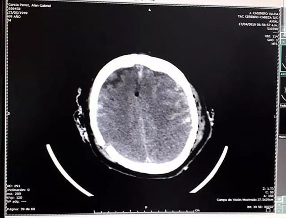 انتحار رئيس بيرو السابق (آلان جارسيا) هربا من اعتقاله بتهم الفساد! صورة رقم 3
