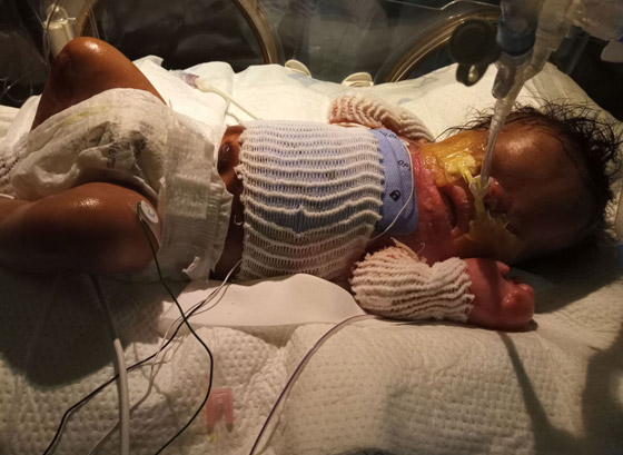 حالة طبية نادرة: طفل يولد بدون جلد يغطي جسمه! صورة رقم 7