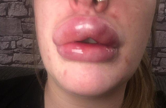 صور صادمة لامرأة بعد عملية نفخ شفاه منخفضة الكلفة صورة رقم 3
